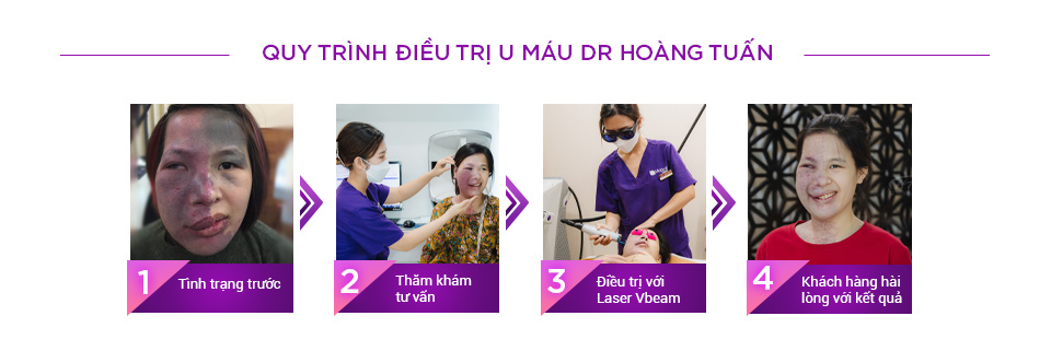 Quy trình điều trị u máu tại Thẩm mỹ Hoàng Tuấn